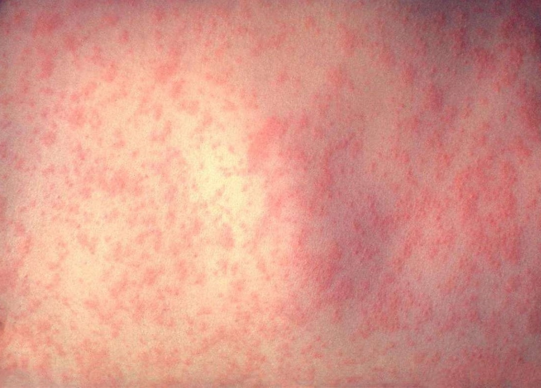 Morbillo, numero di casi in aumento