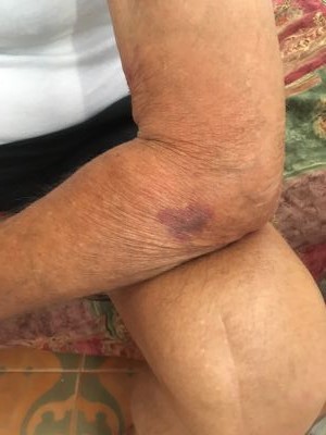 Mozzecane picchiati per strada da un motociclista