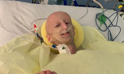 Sammy Basso operato al cuore: ecco come sta il giovane affetto da Progeria