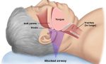 Sindrome delle apnee ostruttive del sonno ambulatorio a San Bonifacio