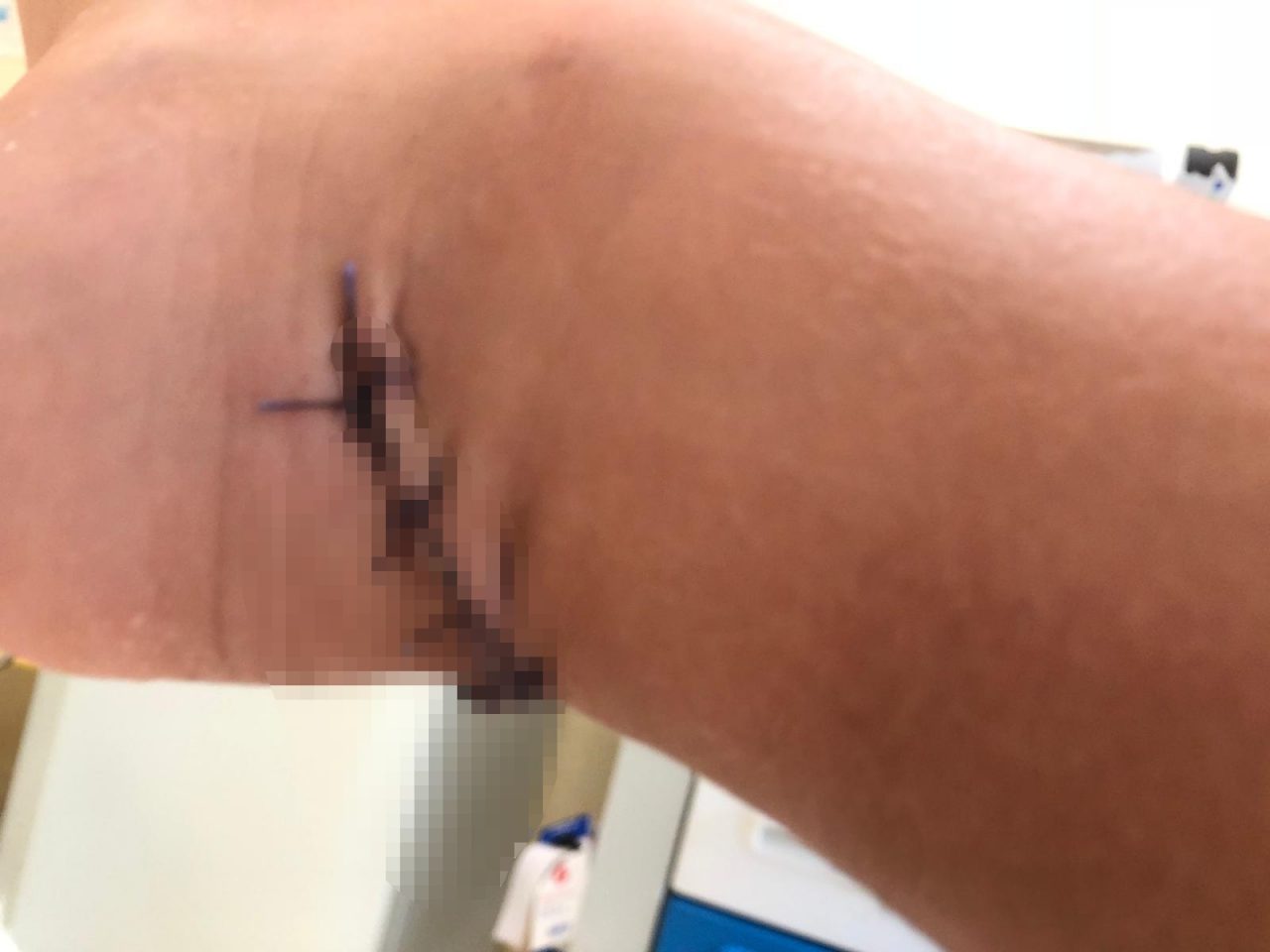 Bambino si appoggia al banco frigo del Migross e si lesiona il tendine di achille FOTO shock