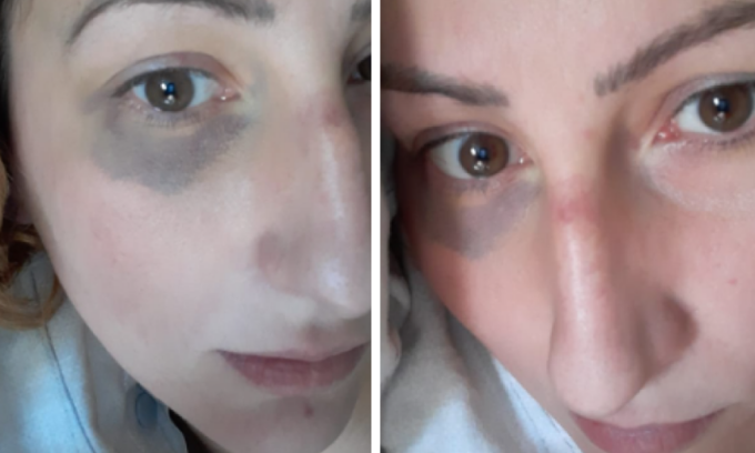 Cerca di uccidere il fidanzato per 3 volte di fila: pochi mesi fa pubblicava sui social foto con i lividi accusando l’ex