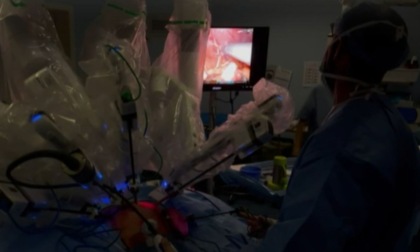 Primo trapianto di rene interamente robotico in Veneto: due fratelli operati con una cicatrice di soli 6 cm a Verona